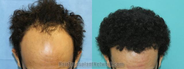 Top view - Before and after hair restoration results