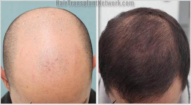 Hair restoration procedure before and after photo results