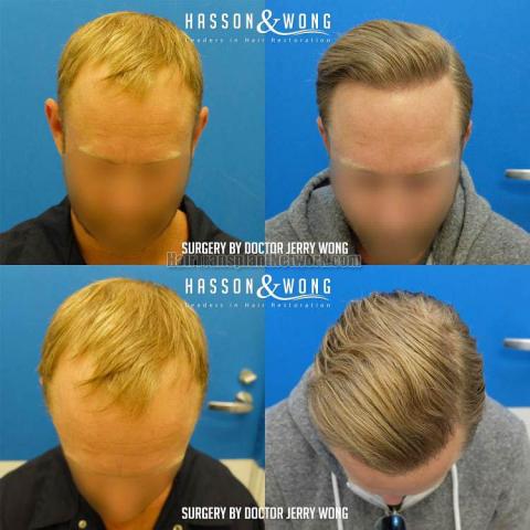 Before and after hair restoration procedure images