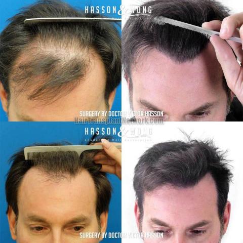 Hair transplantation surgery before and after images