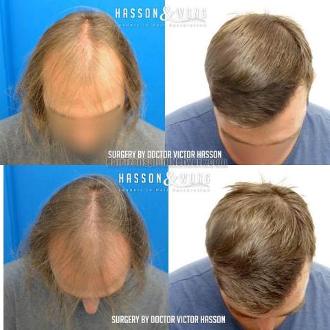 Hair transplantation surgery before and after images