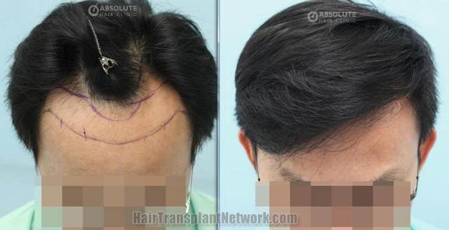 Hair transplantation surgery before and after images