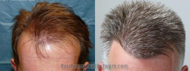 Top view - Before and after hair restoration results