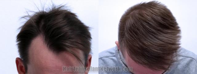 Top view - Before and after hair restoration results