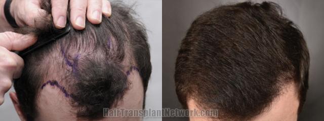 Top view - Before and after hair restoration results