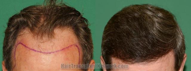 Top view - Before and after hair restoration results