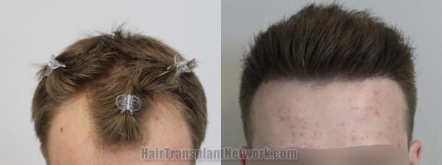 Top view - Before and after hair restoration results