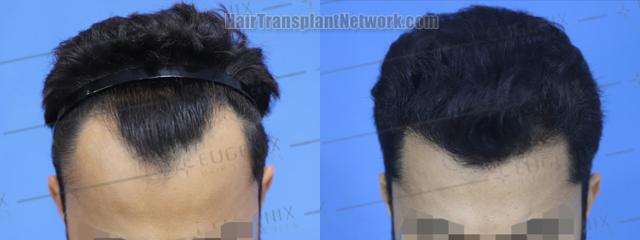 Top view - Before and after hair restoration results