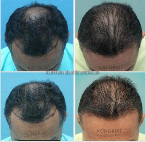 Hair restoration procedure before and after result photos