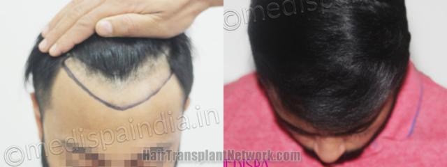 Top view - Before and after hair restoration results