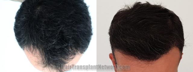 Top view - Before and after hair restoration results