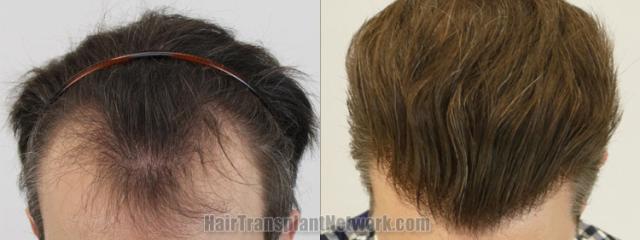 Top view - Before and after hair restoration results