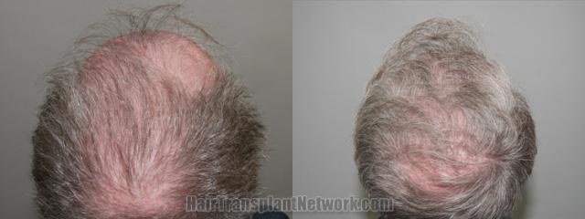 Top view - Before and after hair restoration results