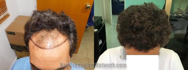 Top view - Before and after hair restoration results