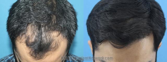 Top view - Before and after hair restoration results