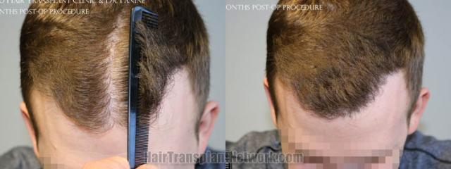 Top view - Before and after hair restoration results