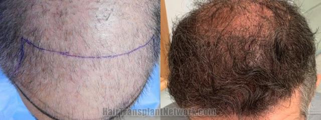 Top view - Before and after hair restoration results