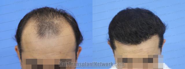 Top view - Before and after hair restoration results