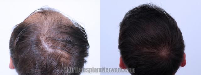 Top view - Before and after hair restoration results