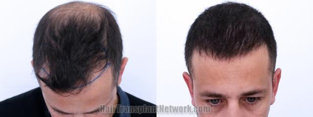 Top view - Before and after hair restoration results