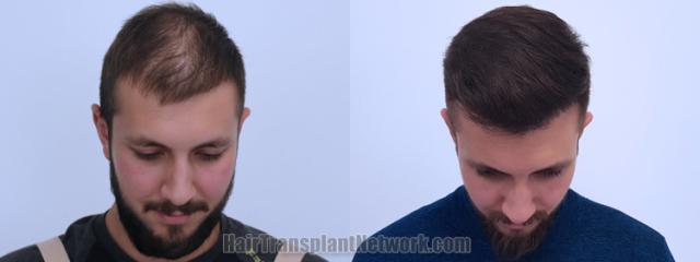 Top view - Before and after hair restoration results