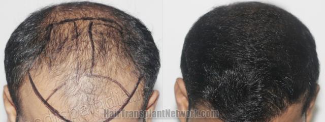 Top view - Before and after hair restoration results