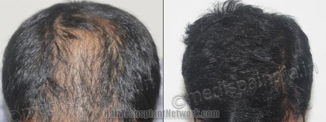 Top view - Before and after hair restoration results