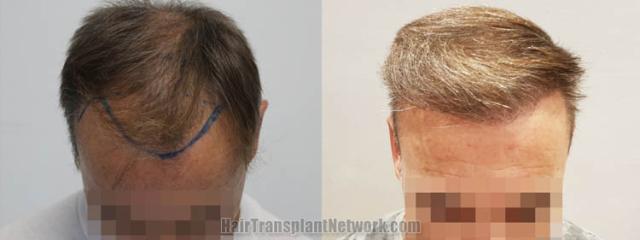 Top view - Before and after hair restoration results