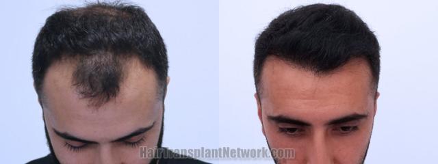 Top view - Before and after hair restoration results