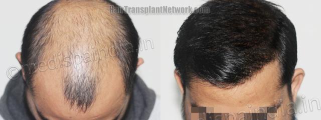 Top view - Before and after hair restoration results