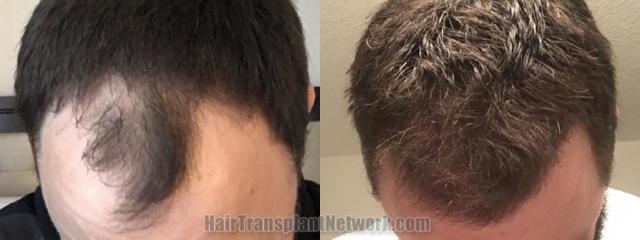 Top view - Before and after hair restoration results