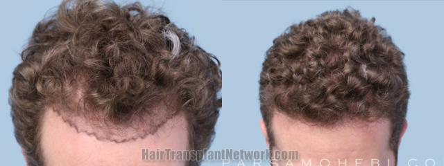 Top view - Before and after hair restoration results