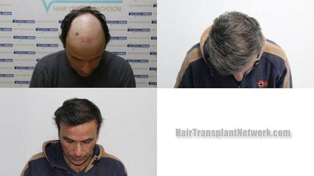 Hair transplantation surgery before and after images