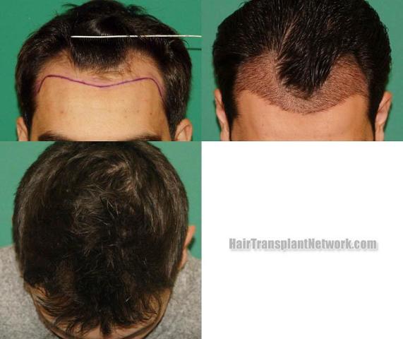 Before and after hair restoration procedure images