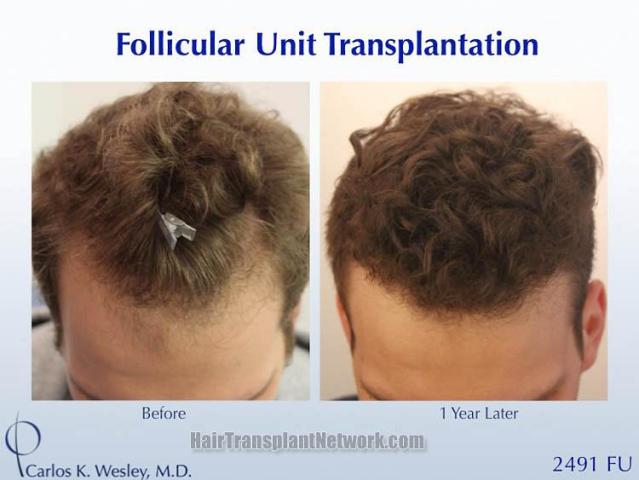 Hair transplantation surgery before and after images