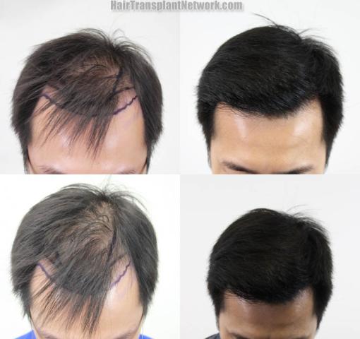 Before and after hair restoration procedure images