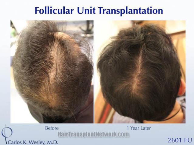 Before and after hair restoration procedure images