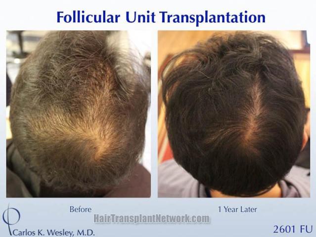 Hair transplantation surgery before and after images