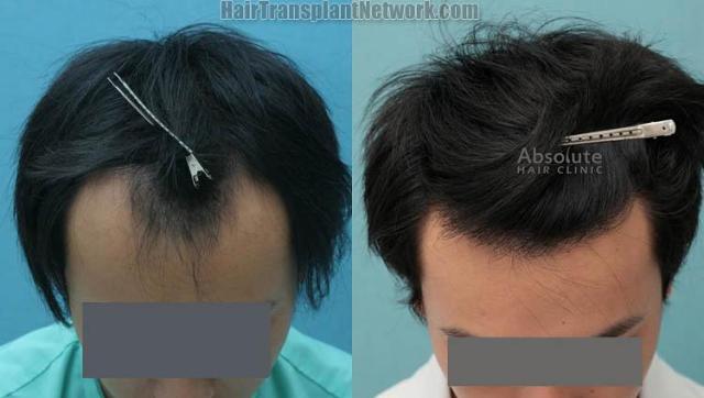 Hair transplantation surgery before and after images