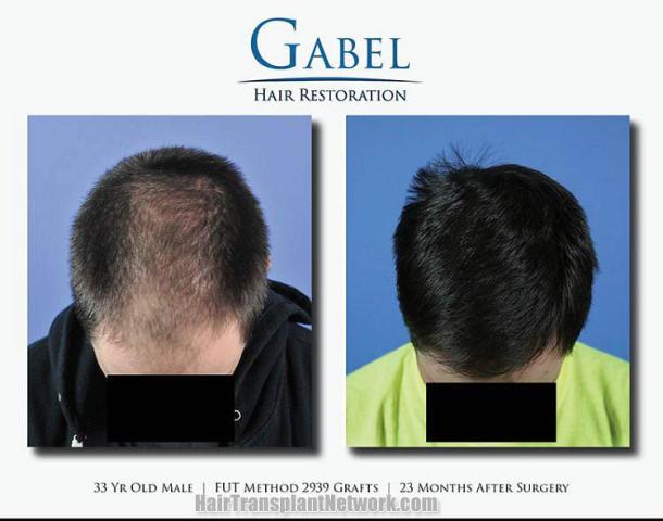 Hair transplantation surgery before and after images