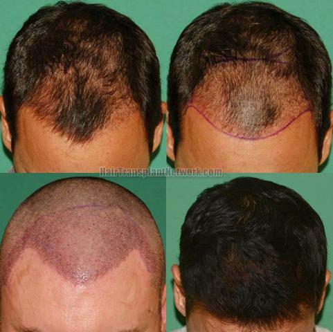 Hair transplantation surgery before and after images