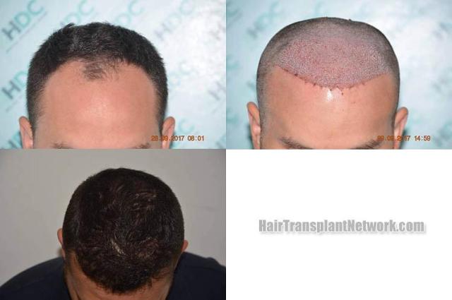 Hair restoration procedure before and after results