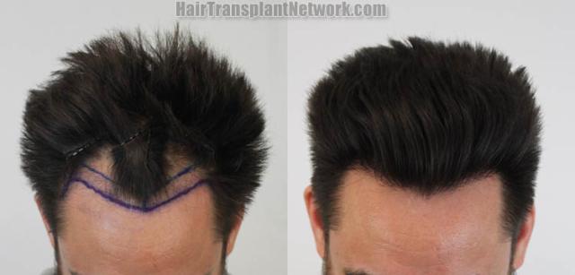 Before and after hair restoration procedure images