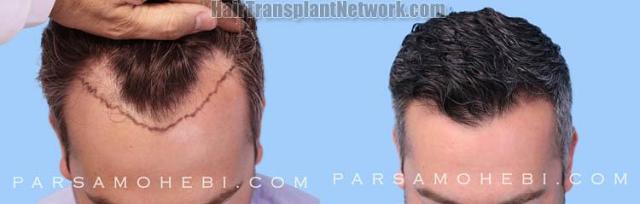 Hair transplantation surgery before and after images