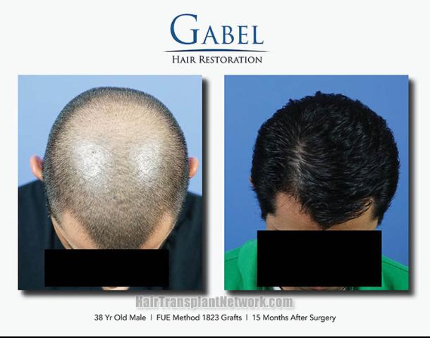 Hair transplantation surgery before and after images