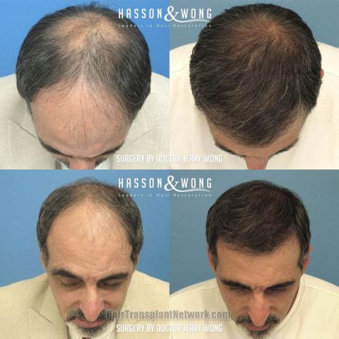 Hair transplantation surgery before and after photos