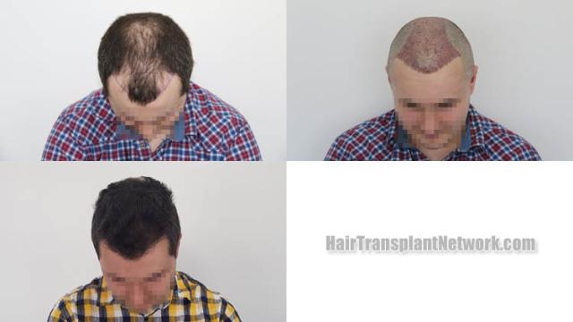 Hair transplantation surgery before and after images