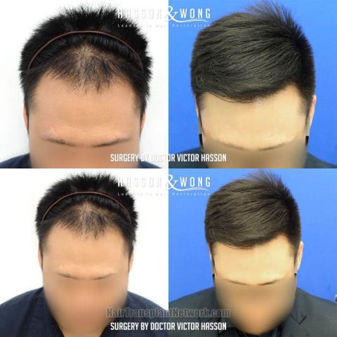 Hair transplantation surgery before and after images