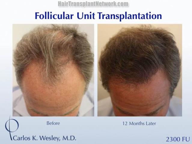 Hair transplantation surgery before and after images