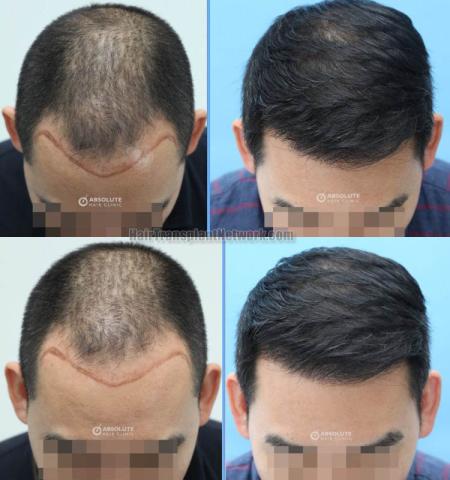 Hair transplantation surgery before and after images